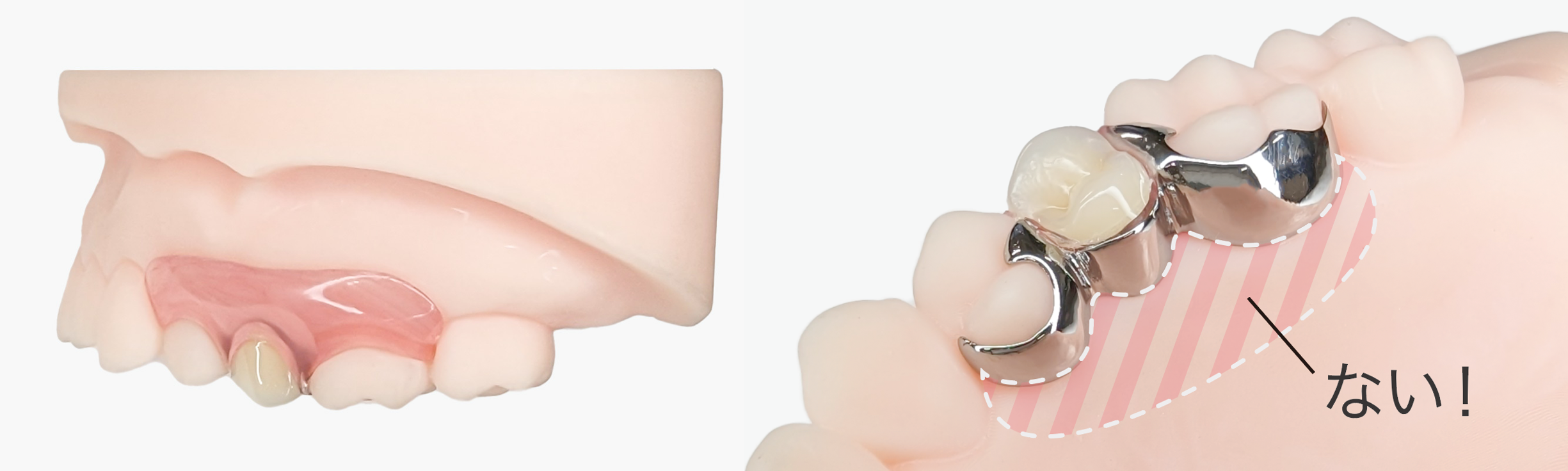 新しい設計の義歯